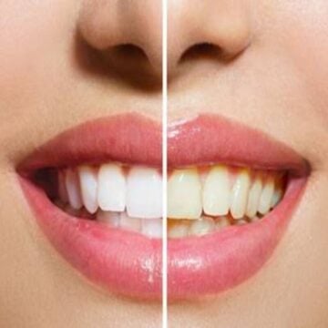 ابتسامتك هتبقى زي المشاهير … أفضل خلطات تبييض الأسنان بمكونات منزلية آمنة