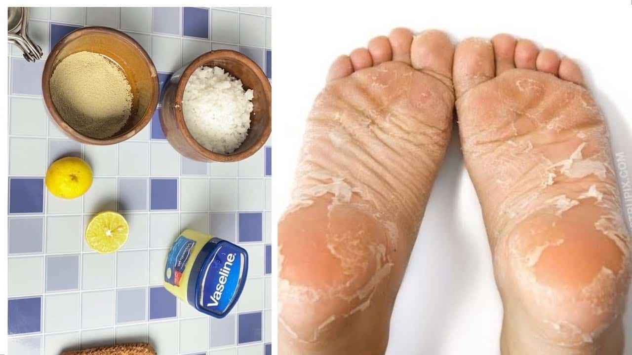 كعبك هينور هيبقي زي القشطة.. مش هتصدقي لو عندك خل هيعمل ايه في كعب رجلك هيزيل الجلد الميت والقشور المتراكمة في دقائق